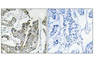 Immunohistochemical analysis of paraffin-embedded human breast carcinoma tissue using BLK (Phospho-Tyr501) antibody (left)or the same antibody preincubated with blocking peptide (right). (BLK Antikörper  (pTyr501))