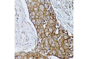 Immunohistochemistry of paraffin-embedded human breast cancer using β-Catenin antibody (ABIN7266137) at dilution of 1:100 (40x lens). (CTNNB1 Antikörper)