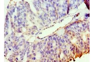 Immunohistochemistry of paraffin-embedded human endometrial cancer using ABIN7169127 at dilution of 1:100 (PAK2 Antikörper  (AA 1-212))