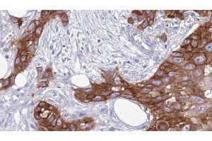 ABIN6277559 at 1/100 staining Human Head and neck cancer tissue by IHC-P. (TYROBP Antikörper  (C-Term))