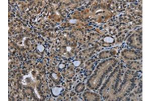 The image on the left is immunohistochemistry of paraffin-embedded Human thyroid cancer tissue using ABIN7129587(GDF3 Antibody) at dilution 1/25, on the right is treated with fusion protein. (GDF3 Antikörper)