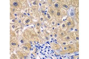 Immunohistochemistry of paraffin-embedded Human liver damage using CARD11 Polyclonal Antibody at dilution of 1:100 (40x lens). (CARD11 Antikörper)