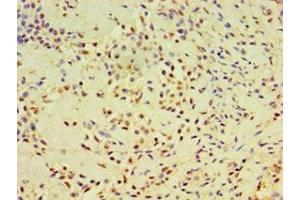 Immunohistochemistry of paraffin-embedded human breast cancer using ABIN7164384 at dilution of 1:100 (DHX58 Antikörper  (AA 389-678))