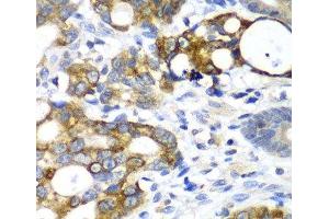 Immunohistochemistry of paraffin-embedded Human gastric cancer using AMY2A Polyclonal Antibody at dilution of 1:100 (40x lens). (AMY2A Antikörper)