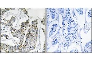 Immunohistochemistry analysis of paraffin-embedded human breast carcinoma, using BLK (Phospho-Tyr501) Antibody. (BLK Antikörper  (pTyr501))