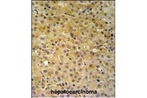 NDUFA10 Antibody (Center) (ABIN653725 and ABIN2843032) IHC analysis in formalin fixed and paraffin embedded hepatocarcinoma followed by peroxidase conjugation of the secondary antibody and DAB staining. (NDUFA10 Antikörper  (AA 252-281))