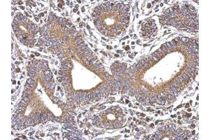 IHC-P Image Immunohistochemical analysis of paraffin-embedded human colon carcinoma, using SERCA3, antibody at 1:500 dilution. (ATP2A3 Antikörper  (N-Term))