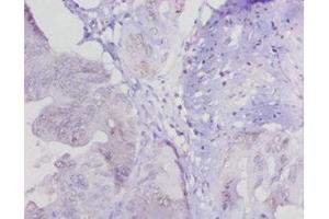 Immunohistochemistry of paraffin-embedded human colon cancer using ABIN7158833 at dilution of 1:20 (LOXL1 Antikörper  (AA 106-574))