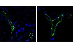 Immunofluorescence analysis of paraffin-embedded human lung cancer(left) and breast cancer(right) cells using CD31 mouse mAb (green). (CD31 Antikörper)