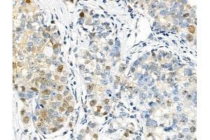 Phospho-p57 Kip2 (Thr310) Antibody at 1/100 staining Human breast cancer and adjacent normal tissues by IHC-P.