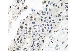 Immunohistochemistry of paraffin-embedded Human lung cancer using CDCA8 Polyclonal Antibody at dilution of 1:100 (40x lens). (CDCA8 Antikörper)
