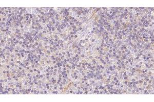 ABIN6273117 at 1/100 staining Human lymph cancer tissue by IHC-P. (FECH Antikörper  (C-Term))