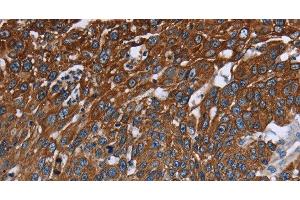 Immunohistochemistry of paraffin-embedded Human lung cancer tissue using FCGR3A Polyclonal Antibody at dilution 1:40 (FCGR3A Antikörper)