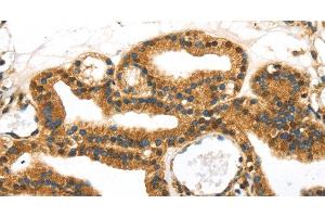 Immunohistochemistry of paraffin-embedded Human thyroid cancer tissue using SERPINB8 Polyclonal Antibody at dilution 1:40 (SERPINB8 Antikörper)