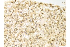 Immunohistochemistry of paraffin-embedded human kidney cancer using PLCB1 antibody. (Phospholipase C beta 1 Antikörper)