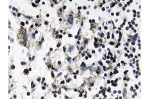 Immunohistochemistry analyzes of Catenin-β antibody in paraffin-embedded human breast carcinoma tissue. (CDC37 Antikörper)