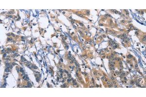 Immunohistochemistry of paraffin-embedded Human colon cancer using SYT17 Polyclonal Antibody at dilution of 1:60 (SYT17 Antikörper)