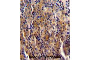 SYNE3 antibody (C-term) immunohistochemistry analysis in formalin fixed and paraffin embedded human hodgkin lymphoma followed by peroxidase conjugation of the secondary antibody and DAB staining. (Nesprin3 Antikörper  (C-Term))