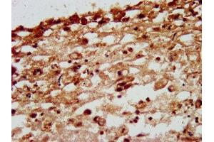 IHC image of ABIN7161596 diluted at 1:200 and staining in paraffin-embedded human melanoma performed on a Leica BondTM system.