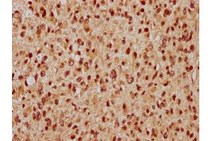 IHC image of ABIN7175822 diluted at 1:300 and staining in paraffin-embedded human glioma performed on a Leica BondTM system. (WAPAL Antikörper  (AA 1037-1190))