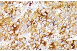 Immunohistochemistry of paraffin-embedded Human liver cancer using GALC Polyclonal Antibody at dilution of 1:100 (40x lens). (GALC Antikörper)