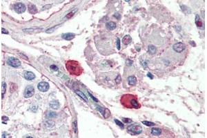 Human Mast Cells (formalin-fixed, paraffin-embedded) stained with Fc Epsilon Receptor 1 (FceR1) antibody ABIN396944 at 10 ug/ml followed by biotinylated anti-mouse IgG secondary antibody ABIN481714, alkaline phosphatase-streptavidin and chromogen. (Fc epsilon Receptor 1 Antikörper)