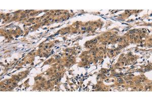 Immunohistochemistry of paraffin-embedded Human gasrtic cancer tissue using ADGRB1 Polyclonal Antibody at dilution 1:40