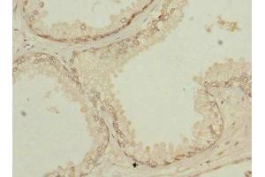 Immunohistochemistry of paraffin-embedded human prostate cancer using ABIN7154259 at dilution of 1:100