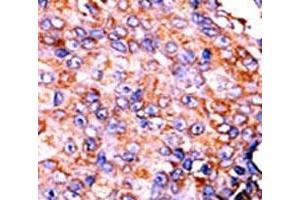 IHC analysis of FFPE human breast carcinoma tissue stained with the p-STAT3 antibody.