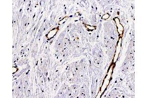 Immunohistochemistry analysis of paraffin-embedded Human hysteromyoma using VWF Polyclonal Antibody at dilution of 1:300. (VWF Antikörper)