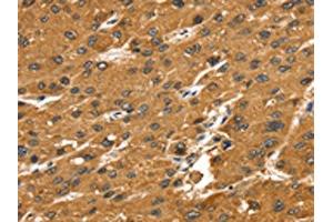 The image on the left is immunohistochemistry of paraffin-embedded Human liver cancer tissue using ABIN7192644(SRGAP1 Antibody) at dilution 1/25, on the right is treated with synthetic peptide. (SRGAP1 Antikörper)