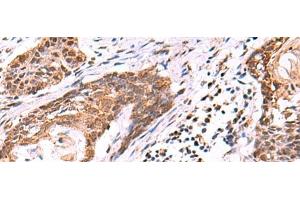 Immunohistochemistry of paraffin-embedded Human esophagus cancer tissue using KATNAL1 Polyclonal Antibody at dilution of 1:95(x200) (KATNAL1 Antikörper)
