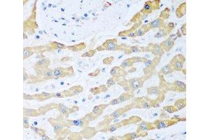 Immunohistochemistry of paraffin-embedded Human liver cancer using FDXR Polyclonal Antibody at dilution of 1:100 (40x lens). (Ferredoxin Reductase Antikörper)