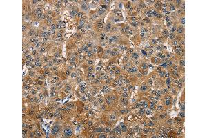 Immunohistochemistry of Human gastric cancer using TRIP4 Polyclonal Antibody at dilution of 1:40