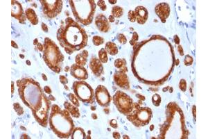 Formalin-fixed, paraffin-embedded human Thyroid Carcinoma stained with Thyroid Peroxidase Mouse Monoclonal Antibody (TPO/1921). (TPO (AA 685-804) Antikörper)