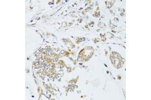 Immunohistochemistry of paraffin-embedded human gastric cancer using MAD2L2 antibody. (MAD2L2 Antikörper  (AA 1-211))