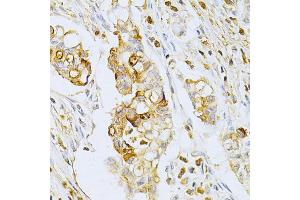 Immunohistochemistry of paraffin-embedded human gastric cancer using OLR1 Antibody (ABIN5970808) at dilution of 1/200 (40x lens). (OLR1 Antikörper)