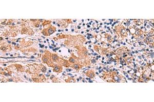 Immunohistochemistry of paraffin-embedded Human liver cancer tissue using IPPK Polyclonal Antibody at dilution of 1:30(x200) (IPPK Antikörper)