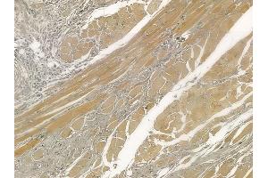 ABIN6257405 and ABIN6273977 at 1/100 staining human tongue carcinoma by IHC-P.