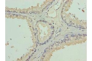 Immunohistochemistry of paraffin-embedded human prostate cancer using ABIN7158010 at dilution of 1:100 (L3MBTL4 Antikörper  (AA 1-270))