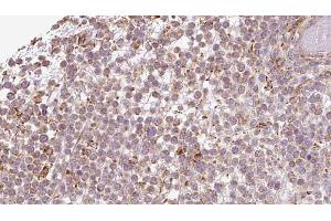 ABIN6273198 at 1/100 staining Human lymph cancer tissue by IHC-P.