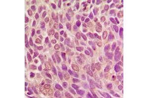 Immunohistochemical analysis of SMAD1 (pS187) staining in human breast cancer formalin fixed paraffin embedded tissue section.