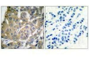 Immunohistochemical analysis of paraffin-embedded human breast carcinoma tissue using Cox2 antibody. (PTGS2 Antikörper)