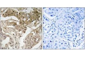 Immunohistochemistry analysis of paraffin-embedded human breast carcinoma, using FOS (Phospho-Thr232) Antibody. (c-FOS Antikörper  (pThr232))