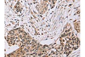 The image on the left is immunohistochemistry of paraffin-embedded Human esophagus cancer tissue using ABIN7130575(PDLIM7 Antibody) at dilution 1/35, on the right is treated with fusion protein. (PDLIM7 Antikörper)