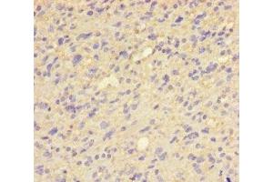 Immunohistochemistry of paraffin-embedded human glioma using ABIN7154027 at dilution of 1:100 (QPCT Antikörper  (AA 29-361))