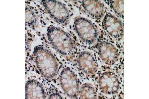 Immunohistochemical analysis of Tyrosyl-tRNA Synthetase staining in human colon cancer formalin fixed paraffin embedded tissue section. (YARS Antikörper  (C-Term))