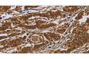 Immunohistochemistry of paraffin-embedded Human gasrtic cancer tissue using GATA5 Polyclonal Antibody at dilution 1:50 (GATA5 Antikörper)