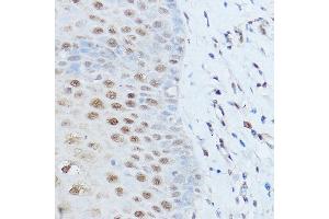Immunohistochemistry of paraffin-embedded human esophageal cancer using SM antibody (ABIN6128718, ABIN6148113, ABIN6148114 and ABIN6215679) at dilution of 1:100 (40x lens). (SMARCD2 Antikörper  (AA 454-531))