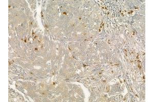 ABIN6260736 and ABIN6276827 at 1/100 staining human lung squamous cell carcinoma by IHC-P.